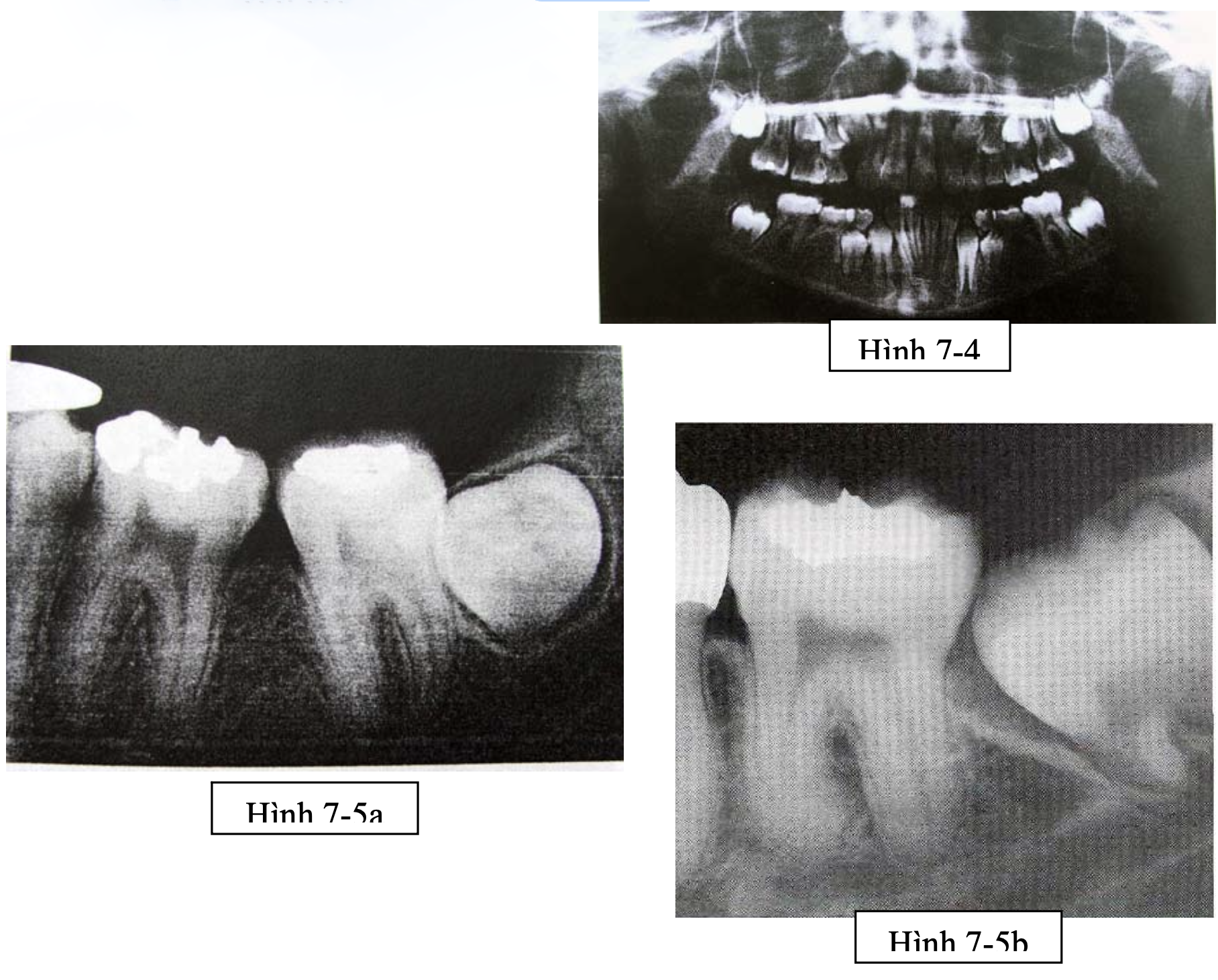 Phẫu thuật lấy mầm răng